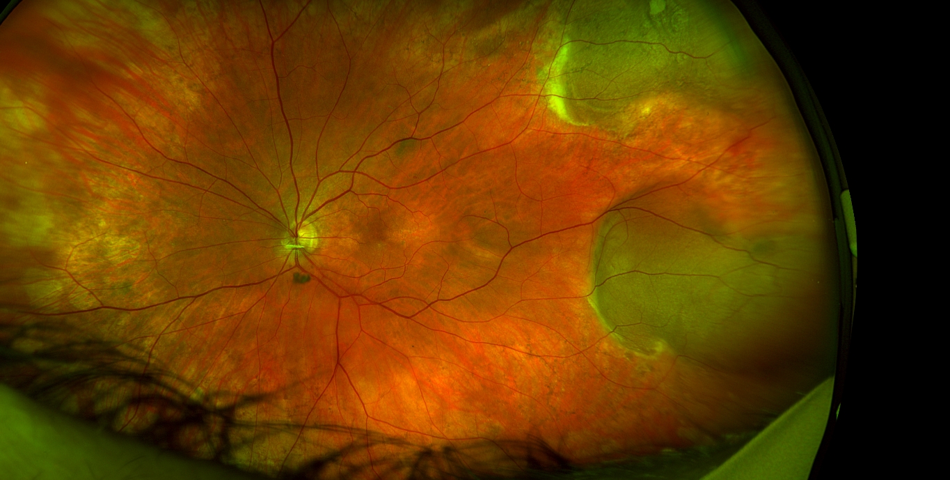 Crystal retinal